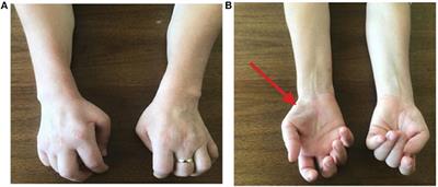 Hirayama Disease: A Case of an Albanian Woman Clinically Stabilized Without Surgery